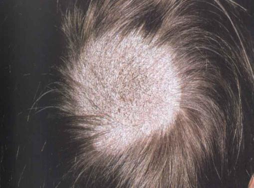 (Black Dot Grey Patch) Alopecia أهم حاجة نفرق ب نها وب ن ال دي ب بقى ف ها scales, black dots (remnants of falling hair) لكن ال Alopecia بتبقى حتة
