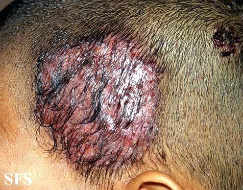 .. 3 أساب ع لل systemic antifungal 7 أساب ع لل topical antifungal ( Tinea Capitis + Bacterial Infection ) أهم حاجة إن الزم أفرق ب نه وب ن ال