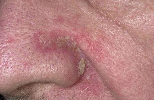 predilection to the body folds Inflammation + Crusts ب بقى عبارة عن