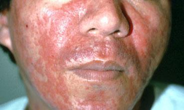 : Diprosalic Lotion (9 LE) مس مرت ن وم ا لو لق تها منتشرة أوي
