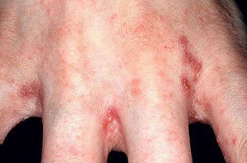 (Insomnia) ب بقى ف ه هرش جامد وب ز د جدا بالل ل لدرجة تمنع الع ان م النوم sebum of hair is anti scabitic ألن ال delicate non hairy areas ب بقى ف ال (Acne = No Scabies) wrist, border of hand &fingers,