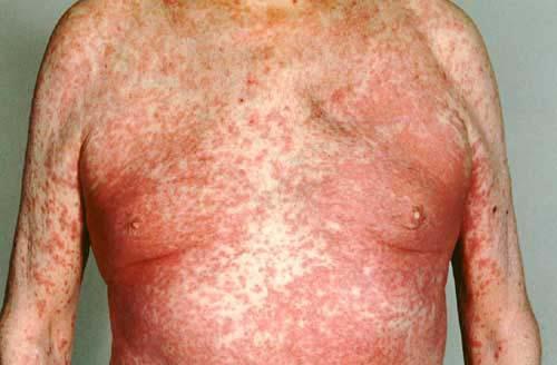 .. مكتوب ف ها Patient has drug eruption plz don t give : 1- All Antibiotic except
