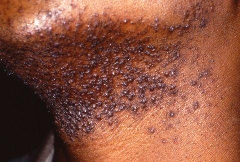 حبوب بتظهر بعد حالقة الذقن ودي عالجها إ ه Topical steroid