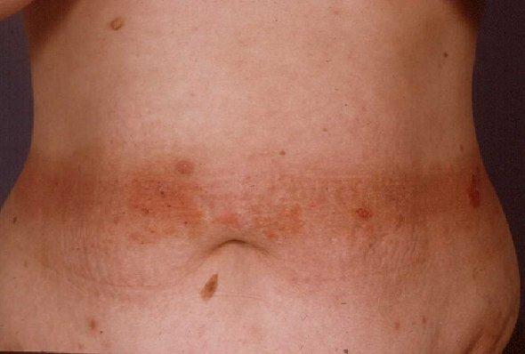 )مش شرط عن الستات والمنظفات( ممكن عمل لنا Chronic Dermatitis - زي الم كان ك الل إ د ه ف الز وت طول النهار أو عامل البناء الل إ د ه