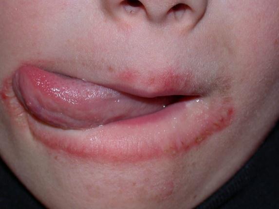 Repeated Licking: Topical Lotions: كت ر ف األطفال.
