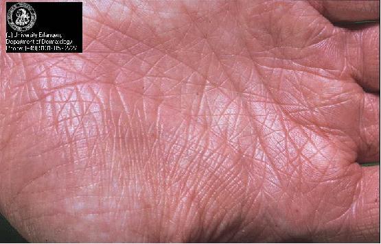 ال Prominent skin fissures &