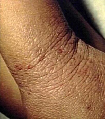 Pathognomonic لل Dermatitis