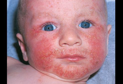 Atopy : A heritable clinical state associated with (Dermatitis Asthma Allergic Rhinitis) Atopic Dermatitis : - Usually chronic pruritic inflammation of epidermis & dermis - often occur in association
