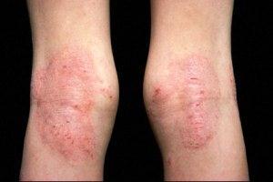 In Older Children & Adults: In elbow, knee (flexor surface) knee و فال cubital fossa واحدة جا ة بتهرش جامد ف ال من ورا ومن قدام )غالبا