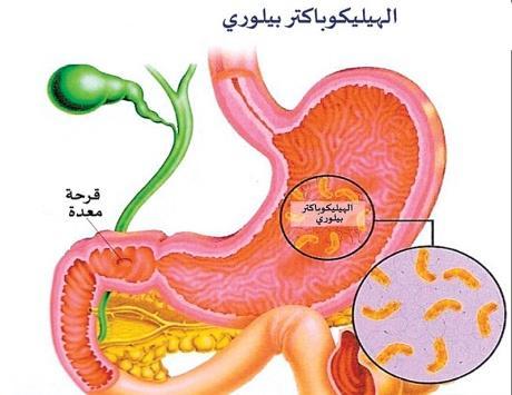 http://wwwalkhaleejae لماوع ةوارضلا ايرتكبل H-pylori( اذه عونلا ايرتكبلا نوكي ارداق ةايحلا ةدعملا ةيرشبلا نلا اذه بوركيملا نوكي ازهجم لكشب ديرف لئاسوب هيعافد هيمحت ضمحلا يدعملا و هذه لئاسولا : -1