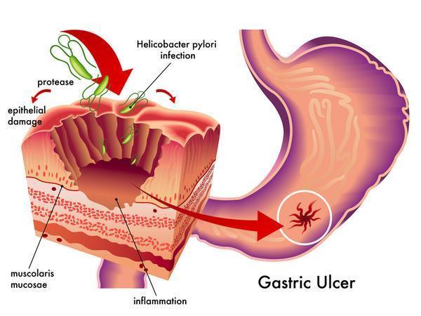 https://wwwgooglefr بابسأ راشتنأ ايرتكب H-pylori( مغرلا نأ يلاوح 21 ةئاملا ناكس ملاعلا نورمعتسم ايريتكبلاب ةينوزلحلا نإف لدعم راشتنلاا فلتخي افلاتخا اريبك بسح رمعلا كلذكو ةلخ دلبلا قرعلاو فورظلاو