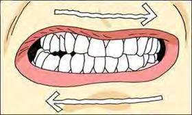 When the periodontal pain involves many teeth, one may consider occlusal overstressing which could be due to occlusal interferences