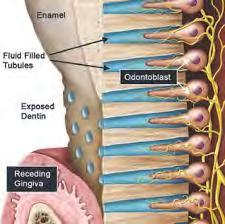 PULPAL PAIN 1. DENTINAL SENSITIVITY In the absence of inflammation, dentinal sensitivity is the mildest form of pulp discomfort.