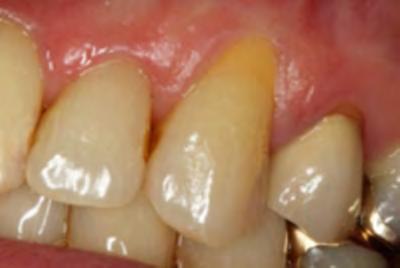 Dentinal sensitivity may also develop when dentin is exposed from gingival recession or following periodontal surgery.