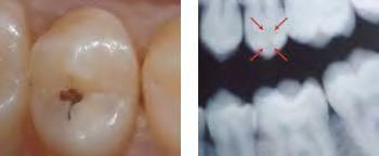 2. REVERSIBLE PULPITIS In reversible pulpitis, pain occurs when a stimulus (usually cold or sweets) is applied to the tooth. When the stimulus is removed, the pain ceases with in 1 to 2 second, i.