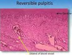 Pulpal recovery is usually seen if reparative cells in the pulp are adequate.