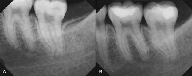 Treatment 1. Removal of the cause if present (caries, fractured restoration, exposed dentinal tubules). 2.