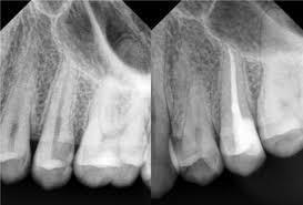 Treatment Complete removal of pulpal tissue should be done, i.e. endodontic therapy.