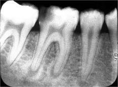 4. NECROTIC PULP It results from continued degeneration of an acutely inflamed pulp. Literal meaning of necrosis is death, that is pulpal tissue becomes dead because of untreated pulpal inflammation.