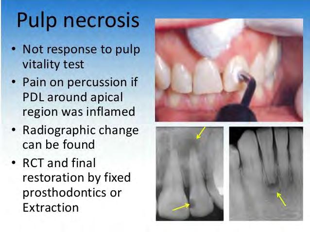 Diagnosis 1. Tooth is usually asymptomatic; may give moderate to severe pain on biting pressure (It is not symptom of necrotic pulp but it indicates inflammation). 2.