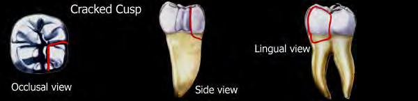 If periradicular periodontitis is present, the tooth will respond with pain to percussion and biting tests regardless of