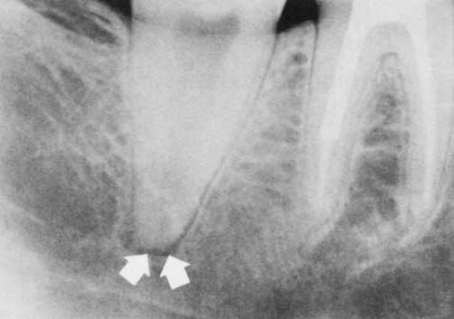 ٴ Diagnosis 1. Check for decay, fracture lines, swelling, hyperocclusion or sinus tracts. 2. Patient has moderate to severe pain on percussion. 3. Mobility may or may not be present. 4.