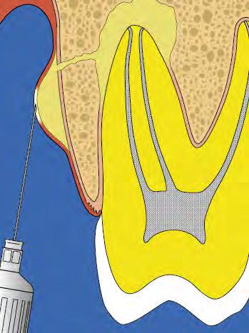2. ACUTE PERIAPICAL ABSCESS Acute periapical abscess is an acute inflammation of periapical tissue characterized by localized accumulation of pus at the apex of a tooth.