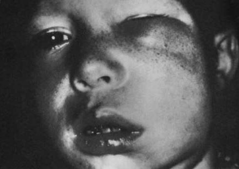 On palpation, tooth may be sensitive. 5. Vestibular or facial swelling in seen in these patients. 6.