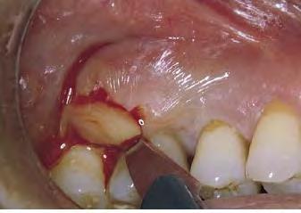 Appropriate analgesics and antibiotics if