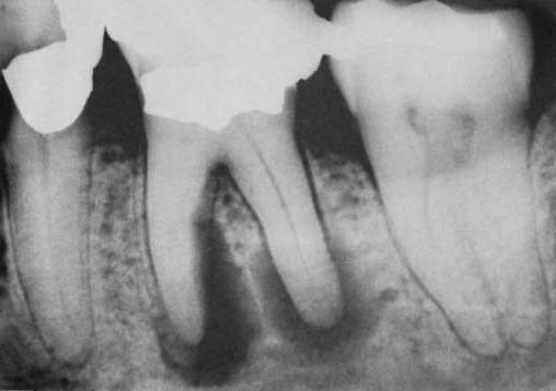 3. CHRONIC APICAL PERIODONTITIS It is caused by necrotic pulp which results from prolonged inflammation that erodes the cortical plate making a periapical lesion visible on the radiograph.