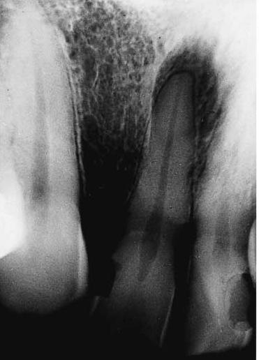 ٴ Diagnosis 1. It is usually asymptomatic but in acute phase may cause a dull, throbbing pain. 2. Pulp tests show nonvital pulp. 3. There is no pain on percussion. 4.