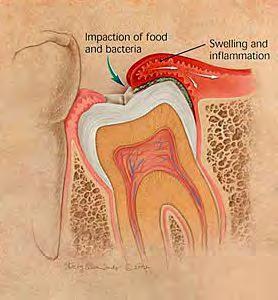 انت ا د Pericoronitis ٴ ٴ ٴ 41 ظ ؽ ا زبع ٤ خ ا ٴاوكوخ ألهؽباء ٥ فنح ا ز اط ؽب خ ا ز بث ٤ خ ازب ٤ خ قث ٣ ز األهؽبء ا ضب ضخ ا ل ٤ خ ) ب ثب جي ؽ )ف ٣ ؾل ٢ ؽو خ ا لي ا ل