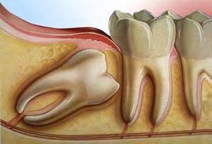 42 Impacted teeth األ ب ا ٴ ٴوح ا ٴ ٴ أ ر ج األ ب ا ٴ ٴوح ر اط غ أ فل ٤ ق ز غ أ ل
