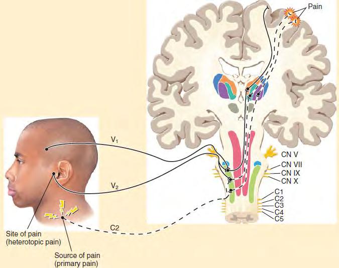 Heterotopic Pain Any pain that is felt in an area other than its true source is heterotopic pain. There are three types of heterotopic pain: referred, central, and projected.