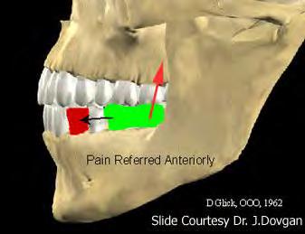 Odontogenic Referred Pain In this pain originates from pulpally involved tooth and is referred to adjacent teeth/tooth or proximating deep and superficial structures.