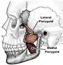 Muscles which are commonly affected are masseter, temporalis but in some cases medial, and lateral pterygoid and digastric muscles are also affected.