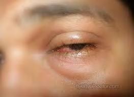 Sometimes edema of the eyelids and face might lead to confusion in diagnosis as these features bear a resemblance to abscess.