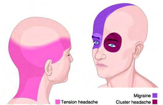 CLUSTER HEADACHE Commonly found in the 