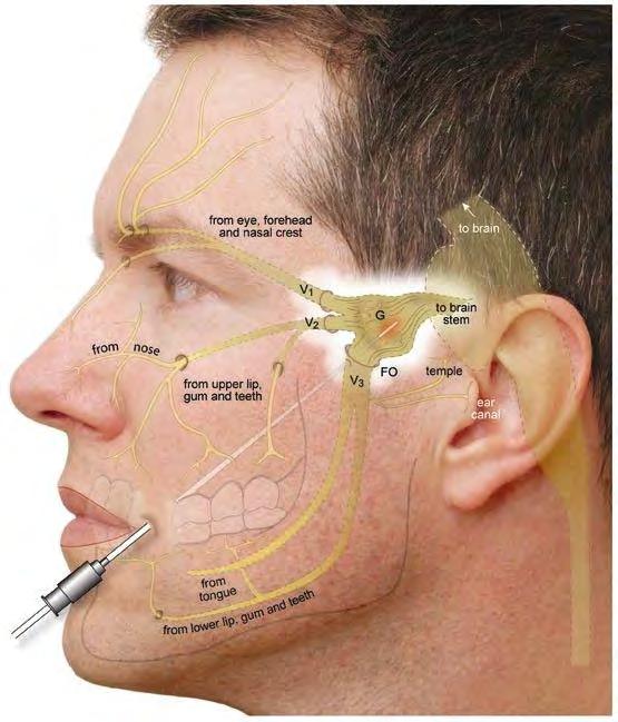 Neuralgia Paroxysmal, unilateral, severe, stabbing or lancinating pain, usually are the characteristics of all paroxysmal neuralgias.