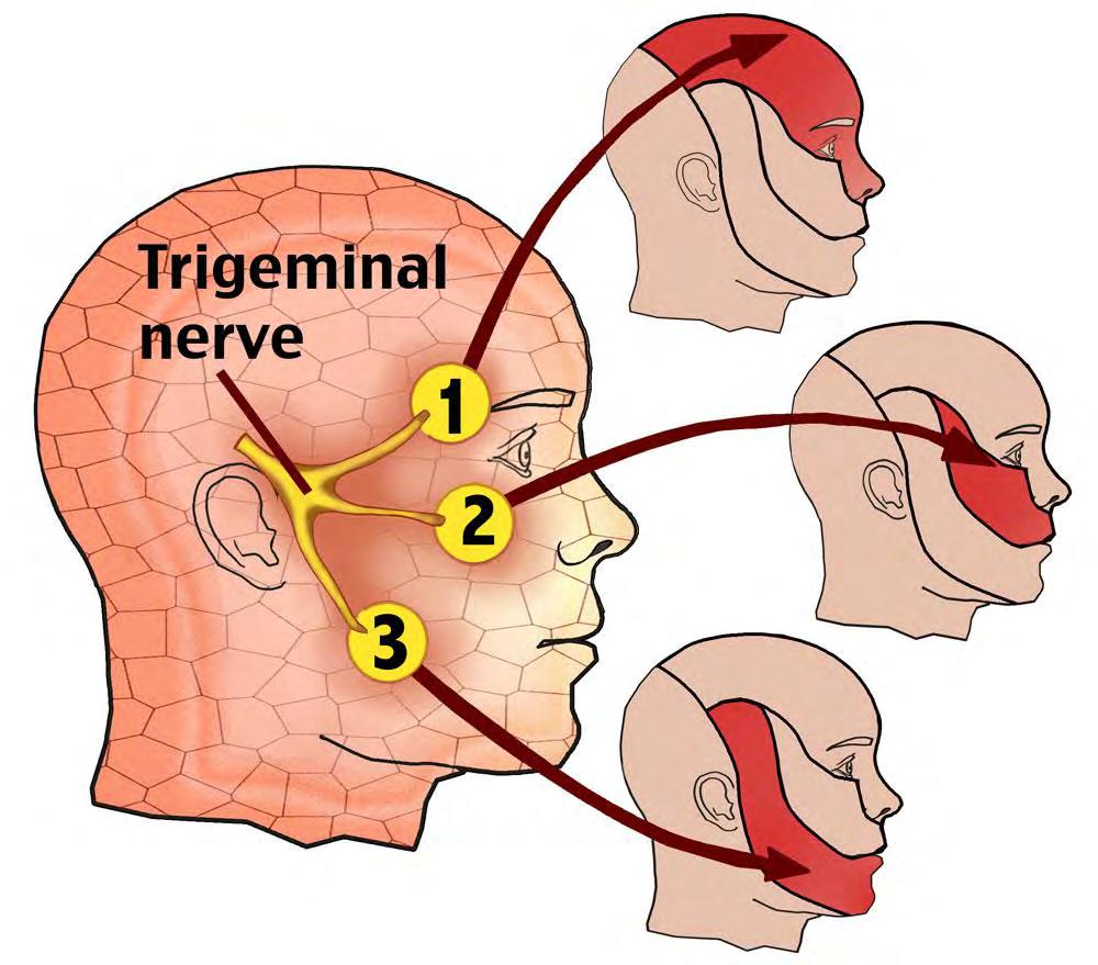 Trigeminal Neuralgia It is also known as Tic Doulourex which has literal meaning of painful jerking Usually characterized by paroxysmal, unilateral, sharp, lancinating pain typically confined to one