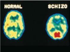 Gambar IV.07 Scan MRI Aktivitas Saraf Korteks Prefrontal Pengidap Skizofrenia Gambar IV.