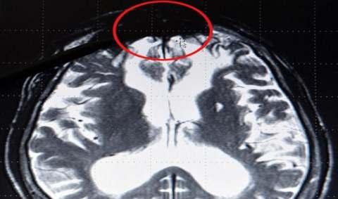 Gambar IV.10 Scan MRI Perbandingan Sinyal Saraf Korteks Prefrontal Pada Orang Normal dan Pelaku Pembunuhan Gambar IV.