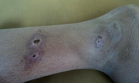 الصورة )1(: تقرحات الجلد الذي يسببه طفيلي اللشمانيا لدى بعض المرضى المصابين باللشمانيا الجلدية.