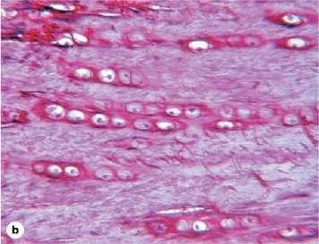 . Fibrocartilage (ECM abundant of collagen fiber ) The chondrocytes in the lacunae are arranged axially.