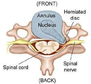 Disc prolapsed If the annulus weakens, the nucleus will protrude outside مادة جيالتينية فسهل تتحرك من مكانها prolapse/herniation.