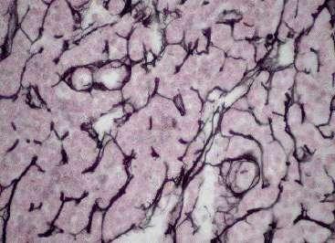 2) Reticular Fibers { means network} Formed by a type of collagen protein that is heavily كربوهيدرات glycosylated. Thinner than Collagen fibers. Stain black with silver impregnation (argyrophilia).