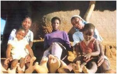 ! او Tشعب بدون اUصابع الفادوما Vadoma هي قبيلة تعيûش يف Tشمال زميبابوي على وادي نهر زامبيزي ولديهم اتüصاالت قليلة مع غالبية البانتو وهناك أاقلية كبرية من هذه القبيلة لديهم حالة وراثية نادرة تعرف