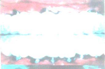 يجب عليك استخدام أسنان صحية مجاورة كمعيار للمقارنة. الصورتان )ج(, وج- 0 : الشيء األكثر عبثية هو أن عملية زراعة الطعوم السنية للرحى ألسباب جمالية ال لزوم له.