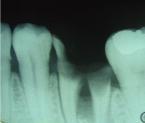 على الحفاظ على اللثة العنقية والمجاورة في صورة نظة على غرار أسناننا الطبيعية فال يمكن